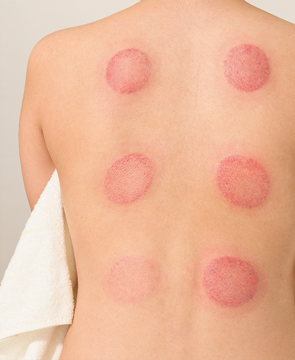 Visible circular marks on the back following Cupping Therapy in Winnipeg, showing typical skin response after suction treatment.